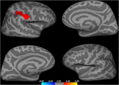 The Higher Parietal Cortical Thickness in Abstinent Methamphetamine Patients Is Correlated With Functional Connectivity and Age of First Usage
